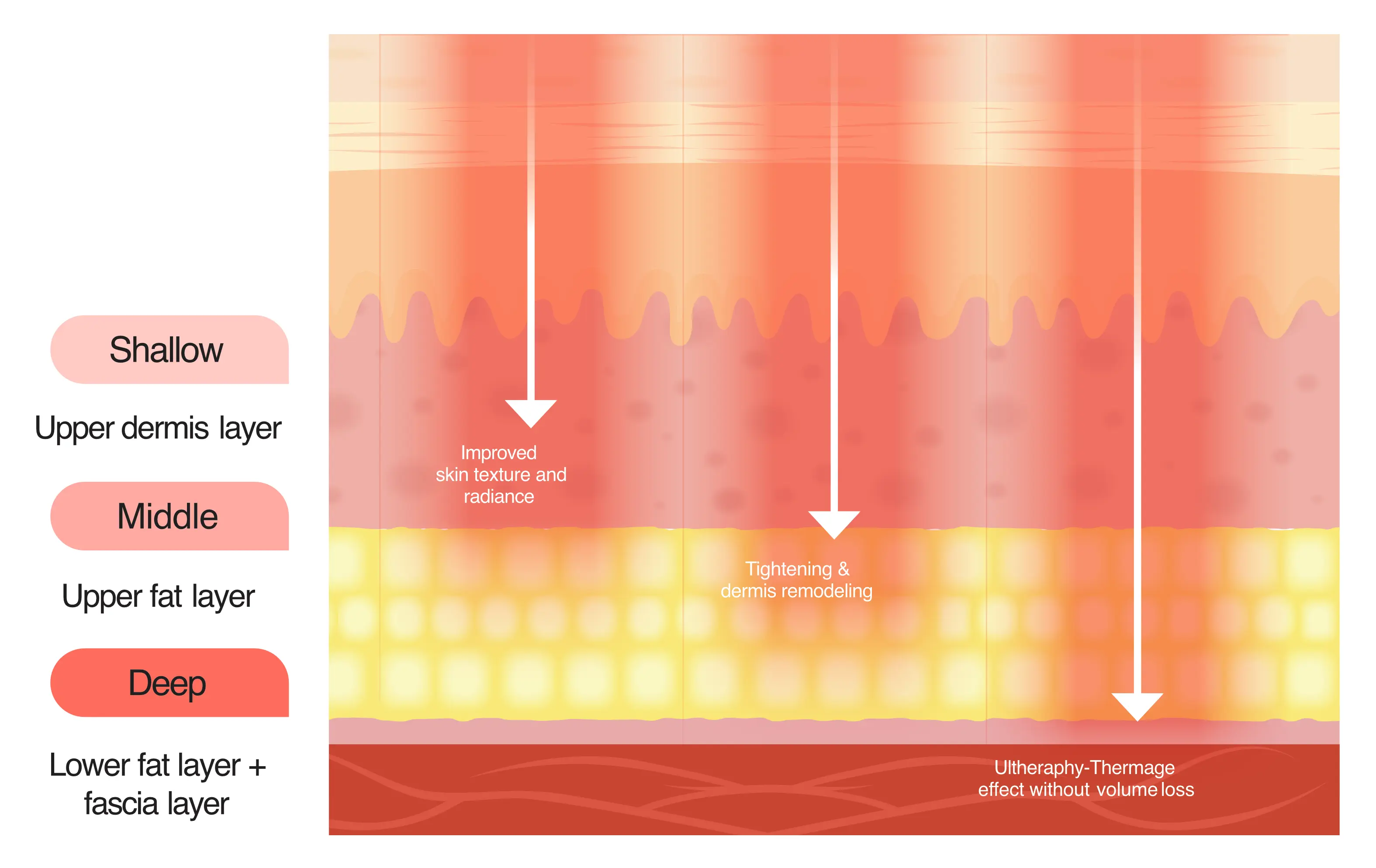 Diagram showing shallow, middle and deep XERF treatment modes across skin and tissue layers